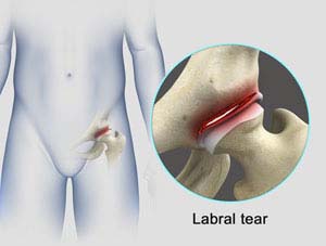 hip labral tear