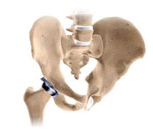 Minimally Invasive Total Hip Replacement