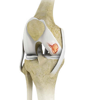 Knee Cartilage Restoration