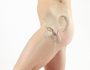 Robotic-Assisted Knee Replacement 