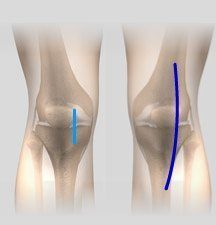 Minimally Invasive Total Knee Replacement