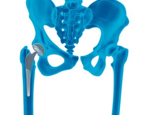 Outpatient Hip Replacement (same day Hip Surgery)
