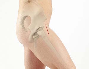 Outpatient Hip Replacement (same day Hip Surgery)