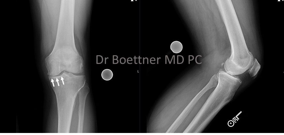 Unicompartmental/Partial Knee Replacement 