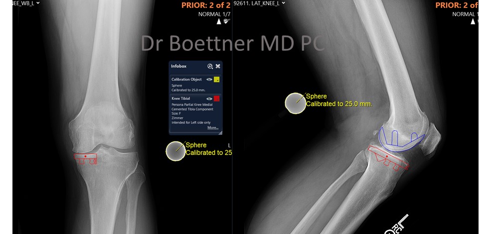 Unicompartmental/Partial Knee Replacement 