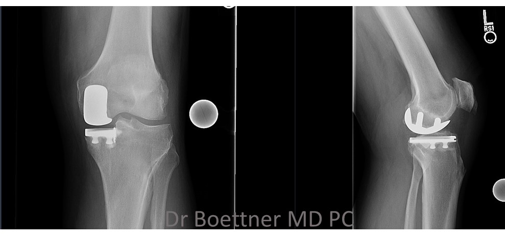 Unicompartmental/Partial Knee Replacement 