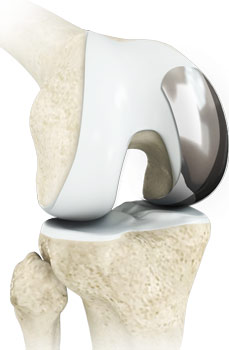 Unicompartmental/Partial Knee Replacement 