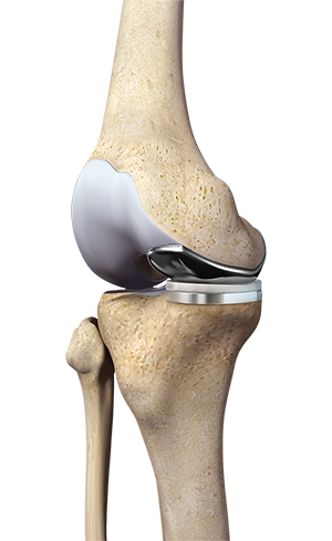 Partial Medial Knee Replacement  