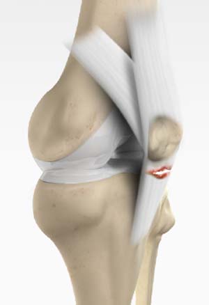 Patellar Tendon Rupture  