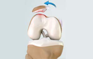 Patellofemoral Instability  