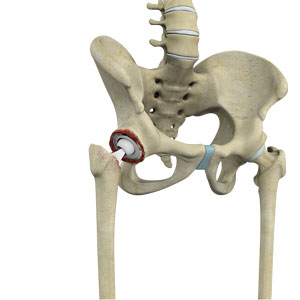 Outpatient Hip Replacement