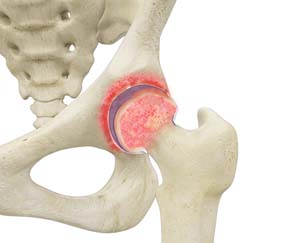 Intraarticular Synovitis