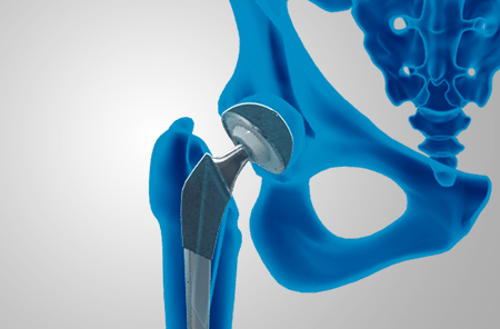 Anterior Hip Arthroplasty