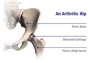 Arthritic Hip