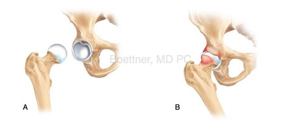 Outpatient Hip Replacement