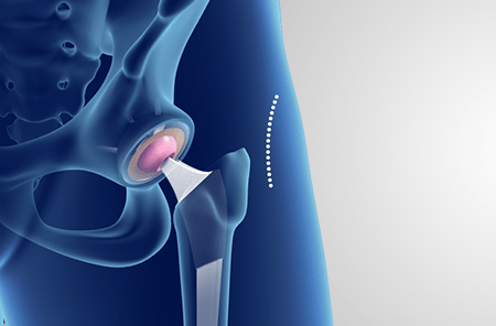 Minimally Invasive Total Hip Replacement