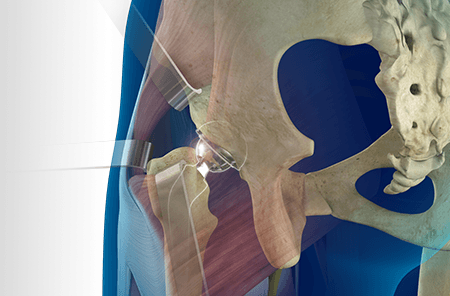 Posterior Hip Arthroplasty