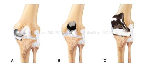 total knee replacement one