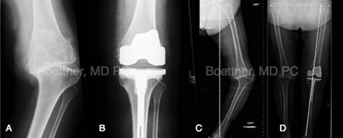 total knee replacement two