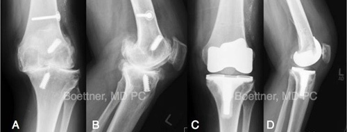 total knee replacement three