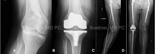 total knee replacement five