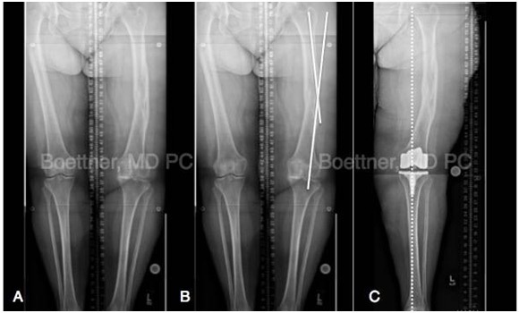 total knee replacement four